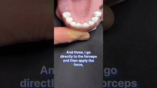 Extractions in the Aesthetic Zone in 3 Steps