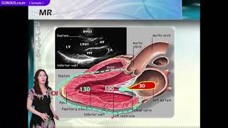 초음파교육_Echo Valve diseases(MV) 강의 샘플영상_SONOUS 대표강사 : 장경미