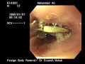 endoscopic coin removal from upper esophagus