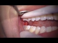 Maxillary Third Molar Extraction