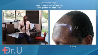 Norwood 5 Level Baldness Restored With 3000 Hair Transplant Grafts | Dr. U