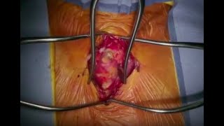 Tracheal stenosis—resection and reconstruction