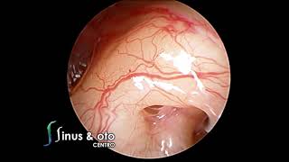 Endoscopic view of promontory blood vessels and otosclerotic focus