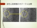 急性心筋梗塞疑いですと言われたら 初期評価からカテーテルまでの流れを循環器医が解説します