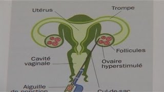 Quelles réalités recouvrent la PMA ?