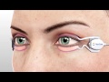 Beverly Hills Optometry - TearCare System for MGD & Dry Eye Relief