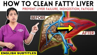 How to Cure Fatty Liver | கல்லீரலில்  கொழுப்பை சுத்தம் செய்வது எப்படி | Dr. Deepthi Jammi