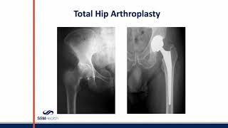 Preparing for total hip or total knee replacement surgery - online class