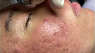 Acne treatment for Spa Linh Mun 2024 #107