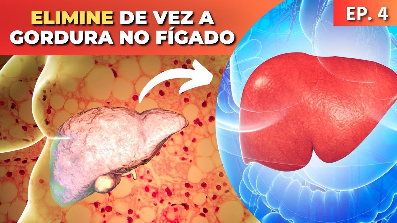 Gordura No Fígado O Que é Sintomas E Como Eliminar De Vez Dr Dayan
