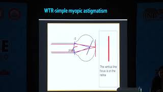 AIOC2019 - IC031 - Tackling astigmatism during cataract surgery - Different strokes.