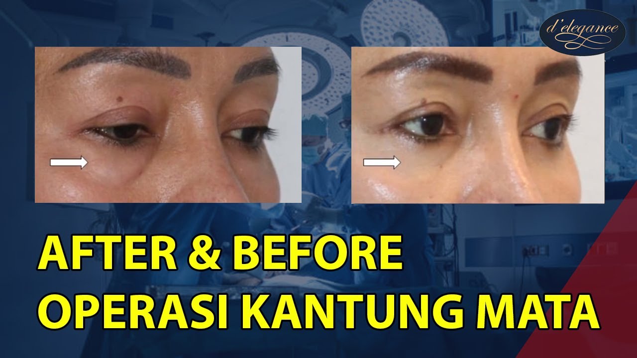 Before After Operasi Kantung Mata - Homecare24