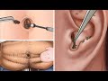 ASMR|Remove Huge Navel Stone Animation|ear blackhead care