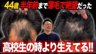 【植毛6ヶ月経過】絶望的な薄毛だった44歳男性が急激に大変身!?