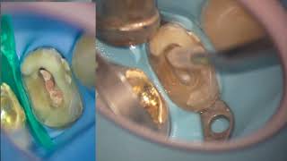 재근관치료시 유용한 기구들 3가지 본문 참고 - Re- endodontic treatment under microscope  ( For dentist )