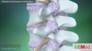 Причины остеохондроза позвоночника