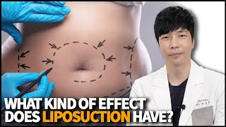 Liposuction: Everything You Need to Know with Doctor Park