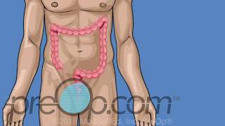 Colonoscopy Procedure - Lower Endoscopy - Lower GI - PreOp® Patient Education