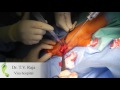 Dr.TV.Raja - Hallux Valgus Surgery - Visa Hospital - Chennai