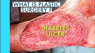 Plastic surgery - Diabetes ulcer