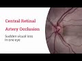 Central retinal artery occlusion