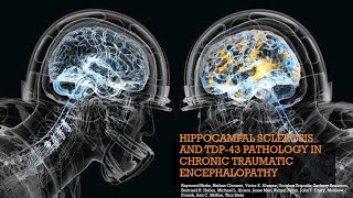 Raymond Nicks, MS - Hippocampal Sclerosis and TDP-43 Pathology in Chronic Traumatic Encephalopathy