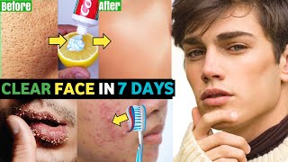 5 COMMON Skin Problems, 5 Easy Solutions For HANDSOME Face | Acne, Dark Skin, Dark Circles