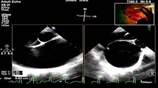 戴维手术+主动脉全弓置换手術直播（一刀未剪） David's Op + Total aortic arch reconstruction