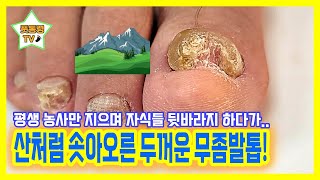 eng [2] 산처럼 솟아오른 두꺼운 무좀발톱! #무좀 #무좀발톱 #레푸스서면점 #레푸스사상점 #레푸스남포점 #레푸스부산 #부산발톱무좀 #임신 무좀발톱 #파고든 발톱