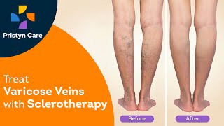 Best Treatment for Varicose Veins | Sclerotherapy