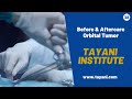 Before & After Orbital Tumor Diagnosis | Tayani Institute