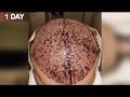 FUE Hair Transplant Timeline I Day 1 to Day 365