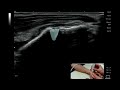 ultrasound evaluation of the thumb 1st cmcj and stt joints