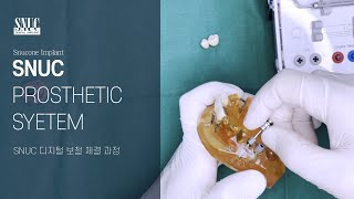 [Snucone Implant] SNUC Prosthetic System SNUC디지털 보철 체결영상