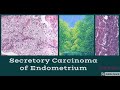 Digital Surgical Pathology 397 Secretory Endometrioid Carcinoma