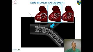 Resolute Onyx for Left Main and bifurcation stenting - Dr Francesco BURZOTTA