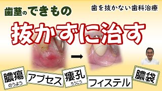 歯茎のできものは、膿瘍、アブセス、フィステル、ろう孔、膿の袋などと呼ばれます。