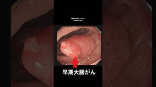 大腸がんの構造#shorts  #雑学 #生活習慣病予防 #病気 #生活