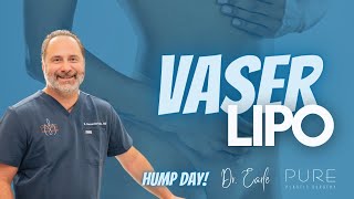 Hump Day Live 🐫 the advantages of VASER Lipo