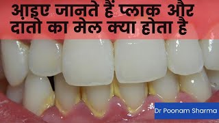 आइए जानते हैं दांतो का मेल या प्लाक क्या होता है और इसको कैसे निकाला जाता है dental plaque.