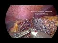 Laparoscopic liver resection for large segment VI haemangioma_Dr Jitendra Mistry_Mission Gastrocare