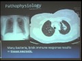 “Tuberculosis in Solid Organ Transplant”