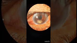 Corneal Spheroidal Degeneration #cornealtransplant #cornea #eyediseases