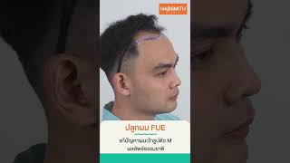 ปลูกผม FUE เพิ่มความมั่นใจ เปลี่ยนเป็นคนใหม่ที่ใช่กว่า #short #ปลูกผมfue #hairtransplantreview