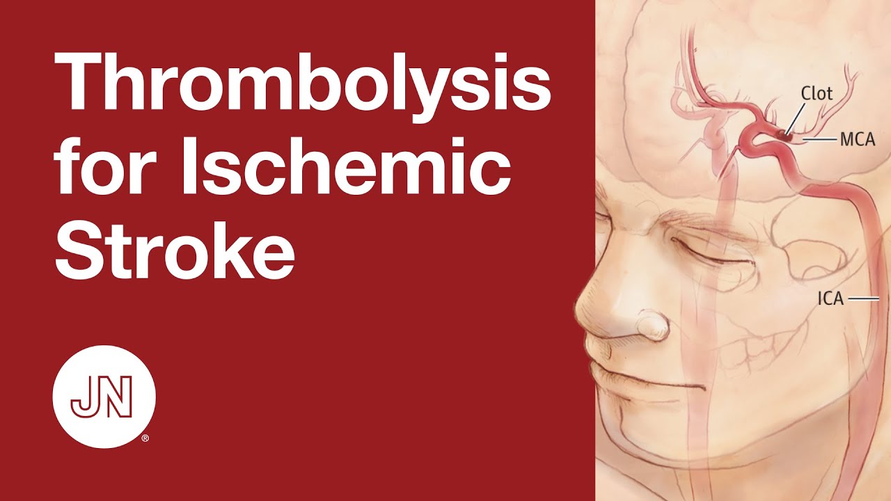 Thrombolysis Before Thrombectomy For Acute Ischemic Stroke - YouTube