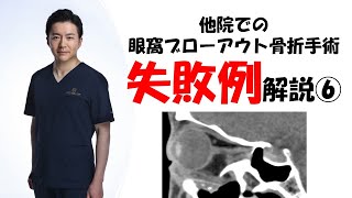 他院の失敗例解説⑥　眼窩ブローアウト骨折骨折手術の失敗例について解説します