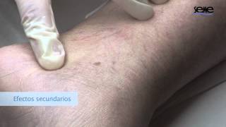 Esclerosis de Varices