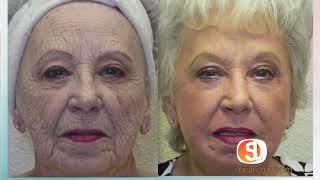 WOW! Look 20 years younger without plastic surgery