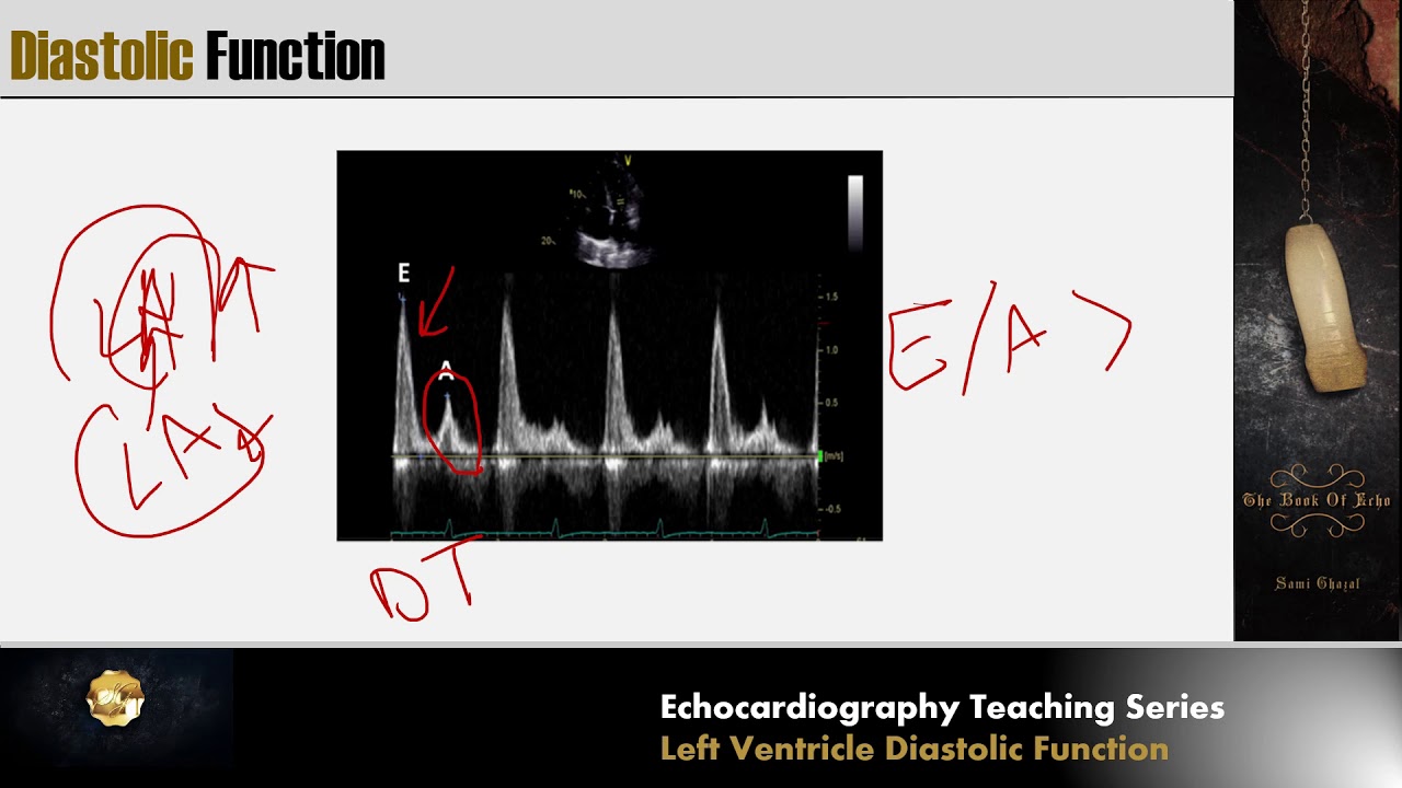 Lecture 6 Lv Diastolic Function Youtube
