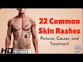 22 Skin Rashes Everyone Should Know About: Symptoms & Treatments